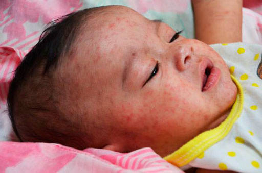 Infant with measles. Photo courtesy of Washington State Department of Health/Centers for Disease Control