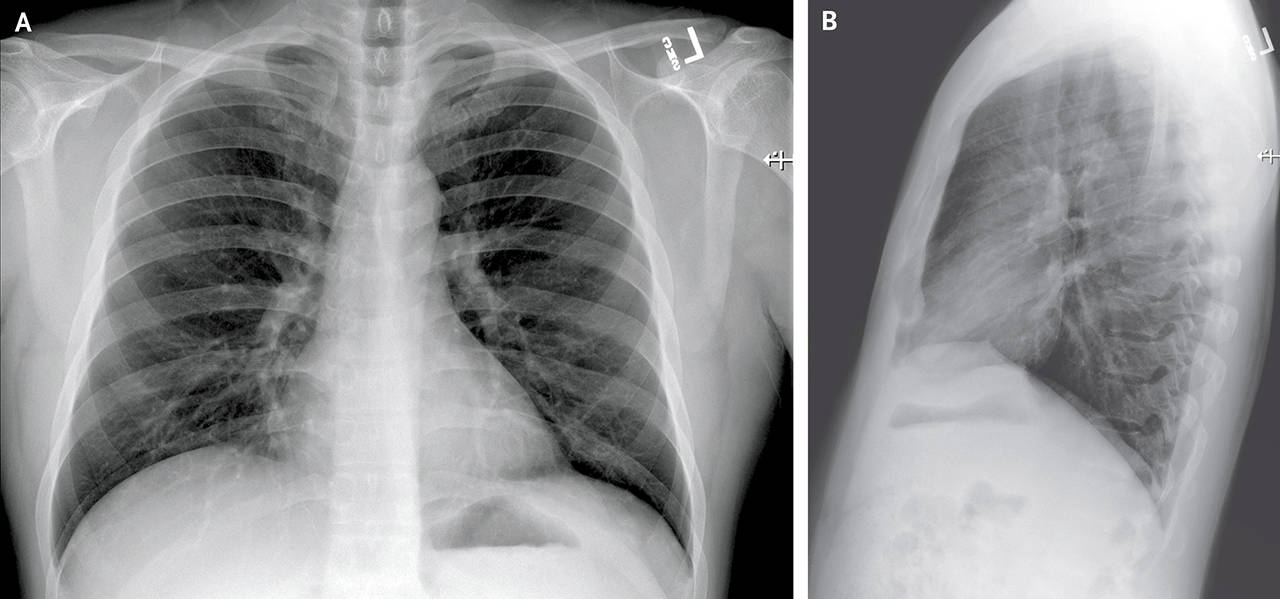 Posteroanterior and Lateral Chest Radiographs, January 19, 2020 (Illness Day 4).No thoracic abnormalities were noted (Snohomish Health District)