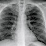 Posteroanterior and Lateral Chest Radiographs, January 19, 2020 (Illness Day 4).No thoracic abnormalities were noted (Snohomish Health District)